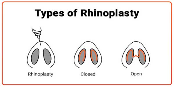 Different-Types-of-Rhinoplasty