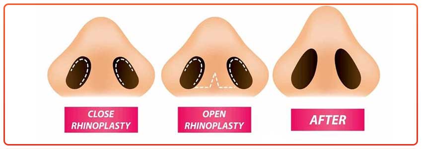 Types-of-Rhinoplasty-&-the-impact-on-cost