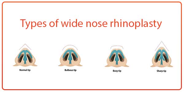 Types-of-wide-nose-rhinoplasty