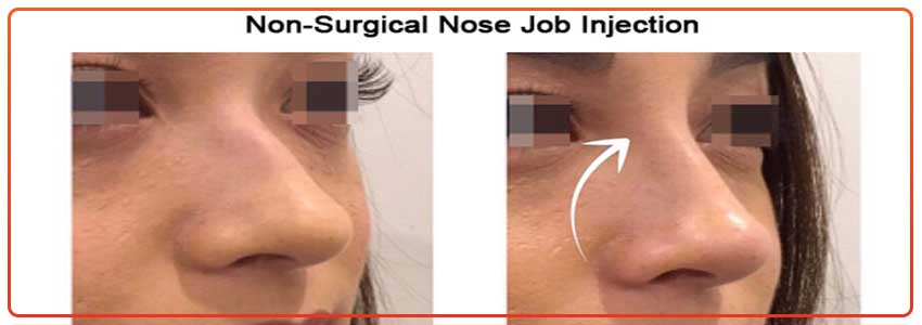 non-surgical-nose-job