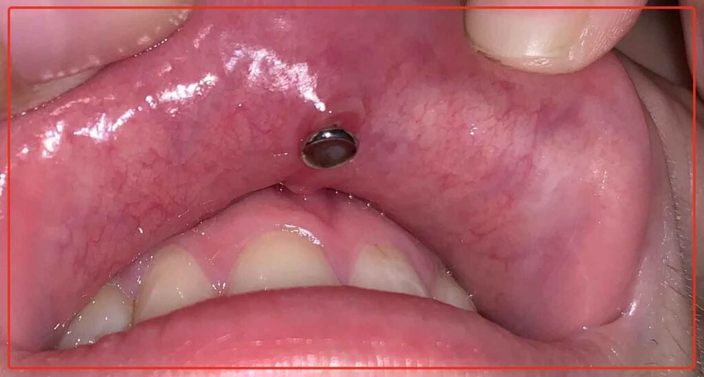 Medusa Piercing Healing Process