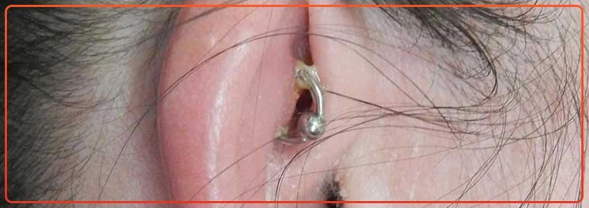 How to Treat An Infected Ear Piercing, According to Dermatologists