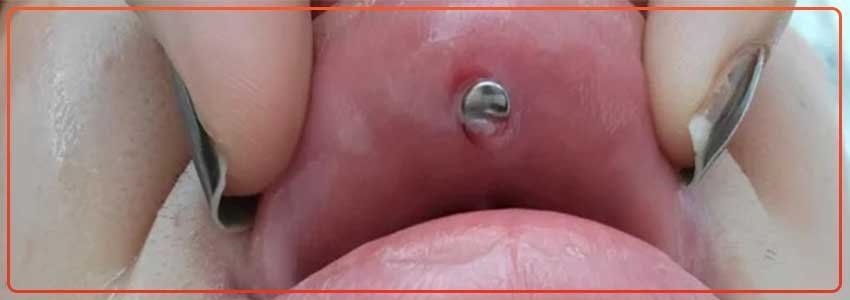 Medusa-Piercing-Swelling-Causes